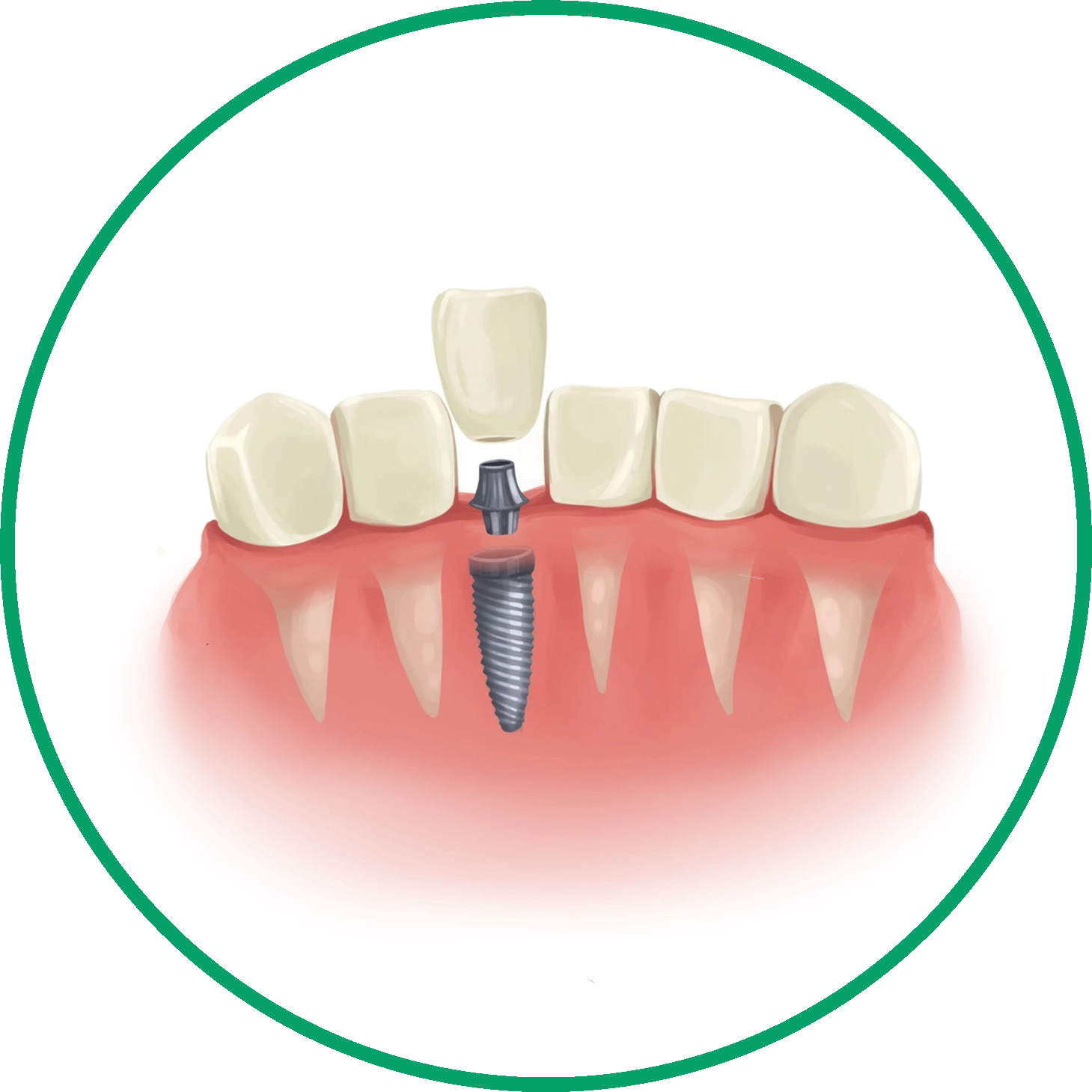 acil diş implantı implant görünümü